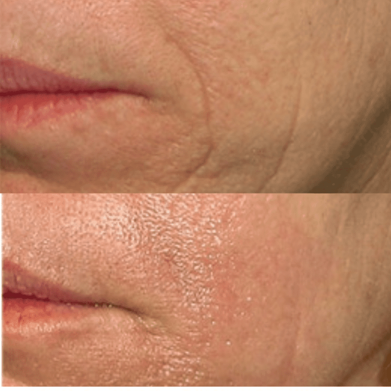 Laser Sciton JOULE® ProFractional
