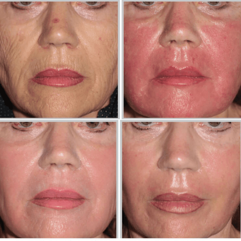 Laser Sciton JOULE® ProFractional