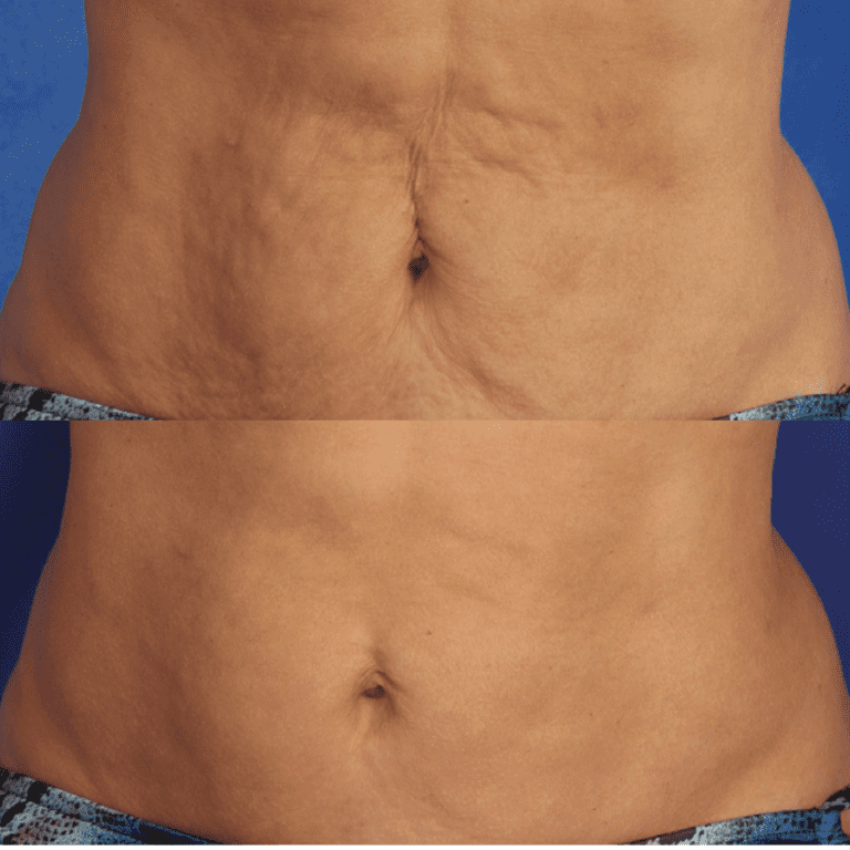 Laser Sciton JOULE® SkinTyte®