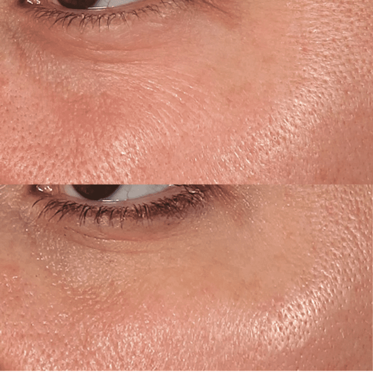 Laser Sciton JOULE® SkinTyte®