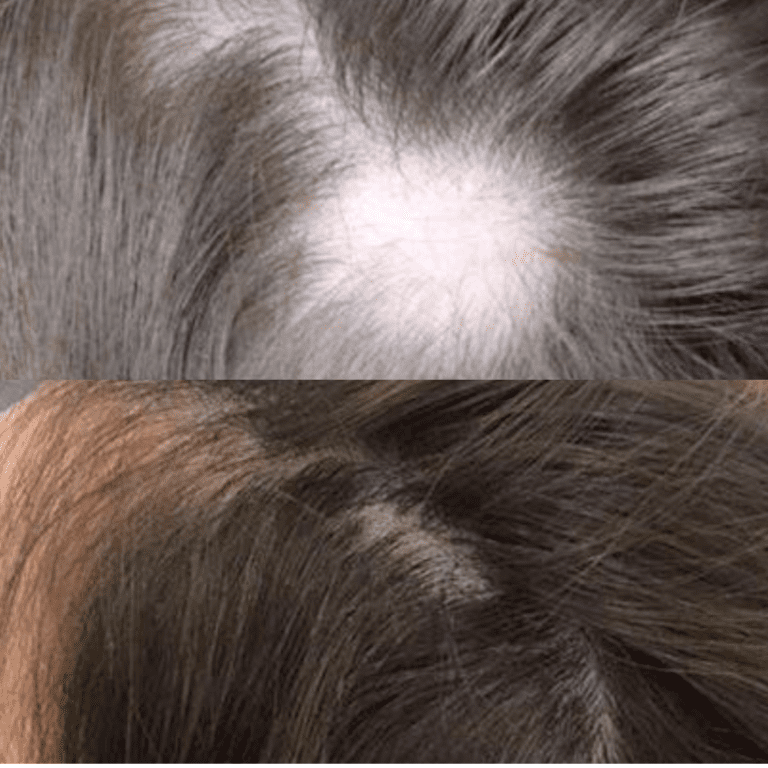 Laser Stellar™ M22 ResurFX Hair