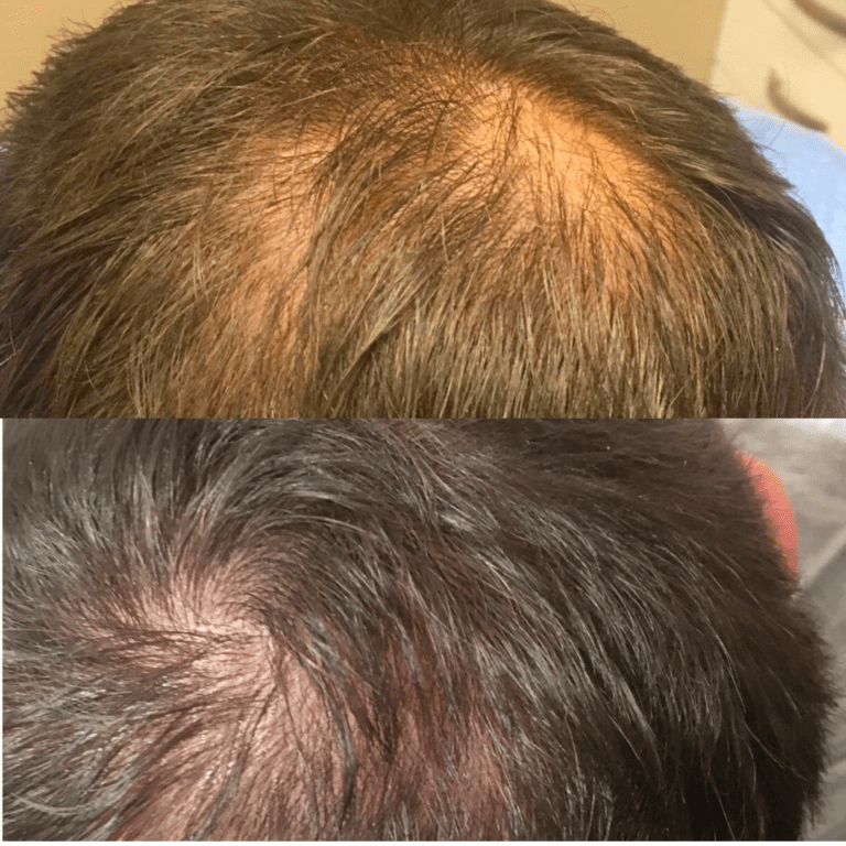 Laser Stellar™ M22 ResurFX Hair