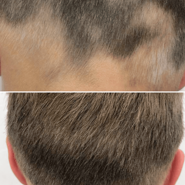 Laser Stellar™ M22 ResurFX Hair