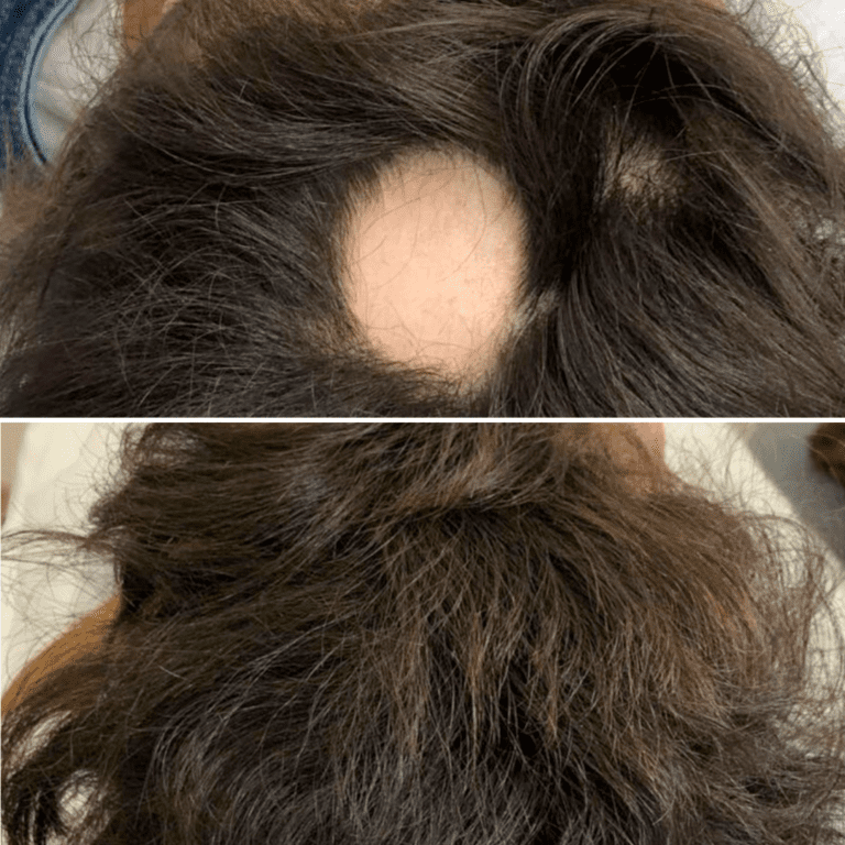 Laser Stellar™ M22 ResurFX Hair