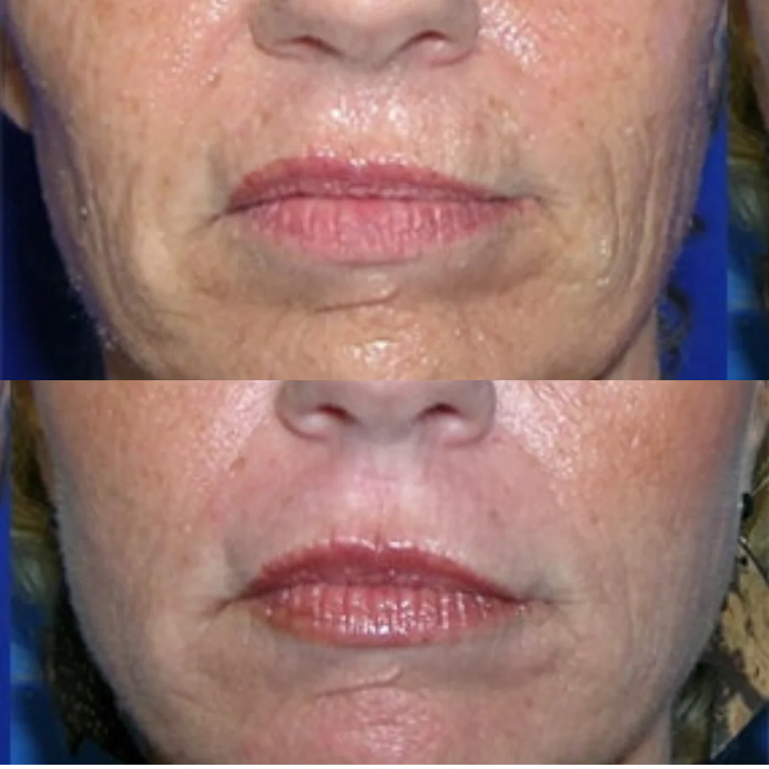 Laser Sciton JOULE® ProFractional